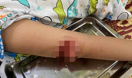 Dấu hiệu nhận biết chó bị nhiễm virus dại và cách phòng ngừa