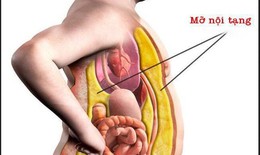 Mỡ nội tạng có hại thế nào với sức khỏe?
