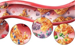 Rối loạn lipid (mỡ m&#225;u): Nguy&#234;n nh&#226;n, triệu chứng, c&#225;ch điều trị v&#224; ph&#242;ng bệnh