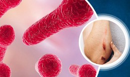Điều trị uốn ván như thế nào?