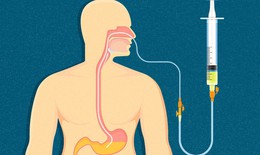 Chăm s&#243;c dinh dưỡng cho người bị uốn v&#225;n
