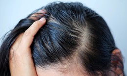 Rụng tóc nhiều vào mùa hè phải làm sao?
