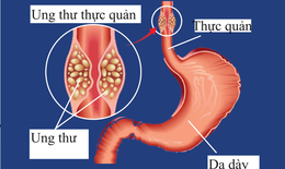 Các loại thuốc điều trị ung thư thực quản