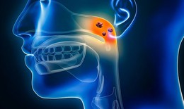Các phương pháp điều trị ung thư vòm họng