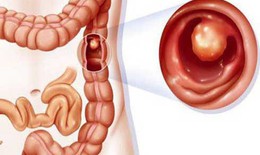 Điều trị ung thư đại tràng như thế nào?