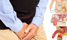 Viêm mào tinh hoàn: Nguyên nhân, triệu chứng và cách điều trị