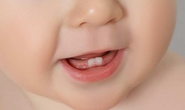 Trẻ mọc răng v&#224; thay răng cần lưu &#253; g&#236;?