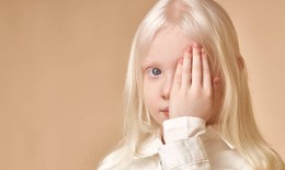 Bệnh bạch tạng có điều trị được không?