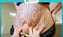Nhồi máu não diện rộng sau hút mỡ tại Viện thẩm mỹ Nguyên Anh