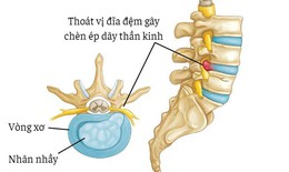 Những lưu &#253; kh&#244;ng thể bỏ qua cho người bị tho&#225;t vị đĩa đệm