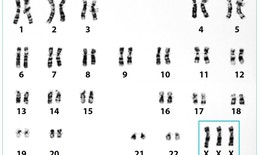 Hội chứng 'siêu nữ’ có điều trị can thiệp được không?