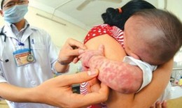 Bệnh sởi, ho gà diễn biến phức tạp, Bộ Y tế nhắc tăng cường phòng, kiểm soát lây nhiễm