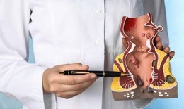 Bệnh trĩ: Nguy&#234;n nh&#226;n, triệu chứng, c&#225;ch điều trị v&#224; ph&#242;ng ngừa