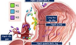 Ung thư dạ d&#224;y: Nguy&#234;n nh&#226;n, biểu hiện, c&#225;ch điều trị v&#224; ph&#242;ng bệnh