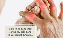 Biến chứng kh&#244;ng thể xem thường của vi&#234;m khớp dạng thấp