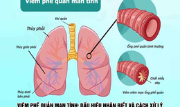Viêm phế quản mạn tính: Dấu hiệu nhận biết và cách xử lý