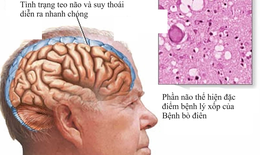 Điều trị bệnh b&#242; đi&#234;n thế n&#224;o?