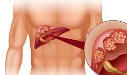 Biểu hiện của bệnh viêm gan ở giai đoạn đầu