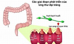 Ung thư đại tràng: Nguyên nhân, biểu hiện, cách điều trị và phòng bệnh