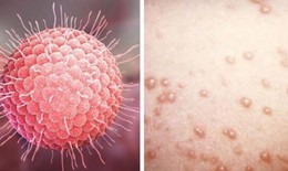 Thủy đậu: Nguyên nhân, triệu chứng, điều trị và cách phòng ngừa