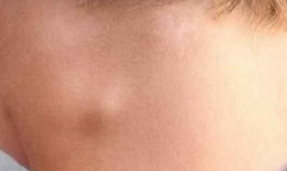 Lao hạch có lây không, triệu chứng thế nào?