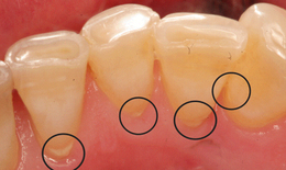 7 biện pháp loại bỏ cao răng tại nhà