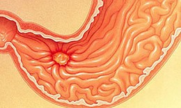 Thuốc v&#224; phương ph&#225;p điều trị vi&#234;m ni&#234;m mạc hang vị dạy d&#224;y