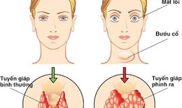 Nguyên nhân, triệu chứng của bướu tuyến giáp và biện pháp cải thiện
