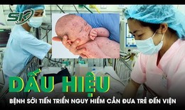 Dấu hiệu bệnh sởi tiến triển nguy hiểm cha mẹ cần đưa trẻ đến viện ngay