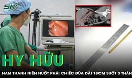 Hy hữu: Nam thanh ni&#234;n nuốt phải chiếc đũa d&#224;i 18cm suốt 3 th&#225;ng