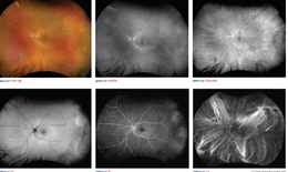 Tiến bộ khoa học công nghệ trong chụp ảnh võng mạc mắt