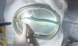 Hi hữu: Người phụ nữ Hải Dương nuốt phải b&#224;n chải khi đang đ&#225;nh răng