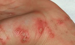 Những bệnh về da thường gặp trong mùa mưa lũ