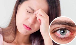 Chăm sóc mắt trong mùa bão lũ cần lưu ý gì?