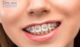 Niềng răng mắc cài kim loại có mấy loại? Nên chọn loại nào tốt?