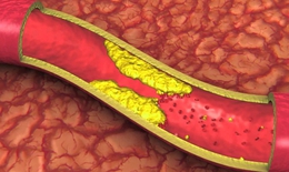 V&#236; sao ki&#234;ng ăn dầu mỡ, c&#225;c chất b&#233;o m&#224; mỡ m&#225;u vẫn cao?