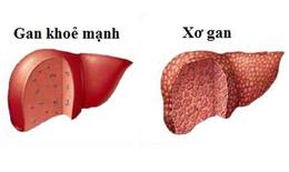 Biểu hiện nhận biết các giai đoạn của bệnh xơ gan