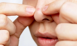 Cách chăm sóc da khỏe mạnh, không mụn độ tuổi dậy thì