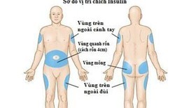 C&#225;c t&#225;c dụng phụ của insulin người đ&#225;i th&#225;o đường cần biết