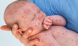 Bị sởi c&#243; n&#234;n tắm kh&#244;ng?
