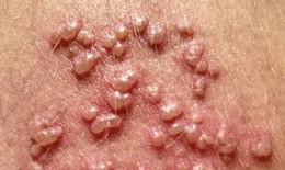 Câu hỏi liên quan bệnh Herpes sinh dục