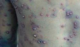 Mắc thủy đậu ở bệnh nhân đái tháo đường sử dụng thuốc và điều trị thế nào?