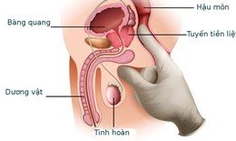 C&#226;u hỏi thường gặp li&#234;n quan đến&#160;ung thư tuyến tiền liệt