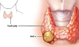 U tuyến giáp Tirads 3 có nguy hiểm không và cách điều trị thế nào?