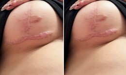 Quy trình cắt sẹo lồi tại phòng khám Edopi