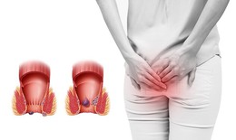 Bệnh trĩ chữa bằng phương pháp nào hiệu quả? cách chăm sóc sau phẫu thuật