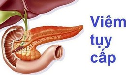 Vì sao uống nhiều bia rượu gây viêm tụy cấp?