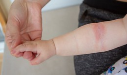 Cách xử trí và giảm tác nhân dị ứng ở trẻ