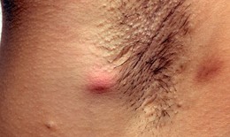 Thực phẩm bổ sung nào hỗ trợ điều trị viêm tuyến mồ hôi mủ?