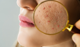 6 dấu hiệu trên da cảnh báo gan cần được chăm sóc ngay